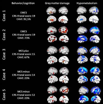 Brain, Behavior, and Cognitive Interplay in Disorders of Consciousness: A Multiple Case Study